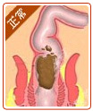 粪便在直肠内成形