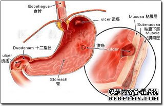 十二指肠球炎的治疗方法